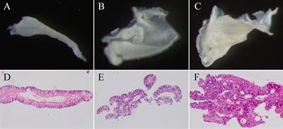 Genome-Wide Analysis of microRNA and mRNA Expression in Colorectal Intramucosal Neoplasia and Colorectal Cancer With a Microsatellite-Stable Phenotype Based on Adenoma-Carcinoma Sequences